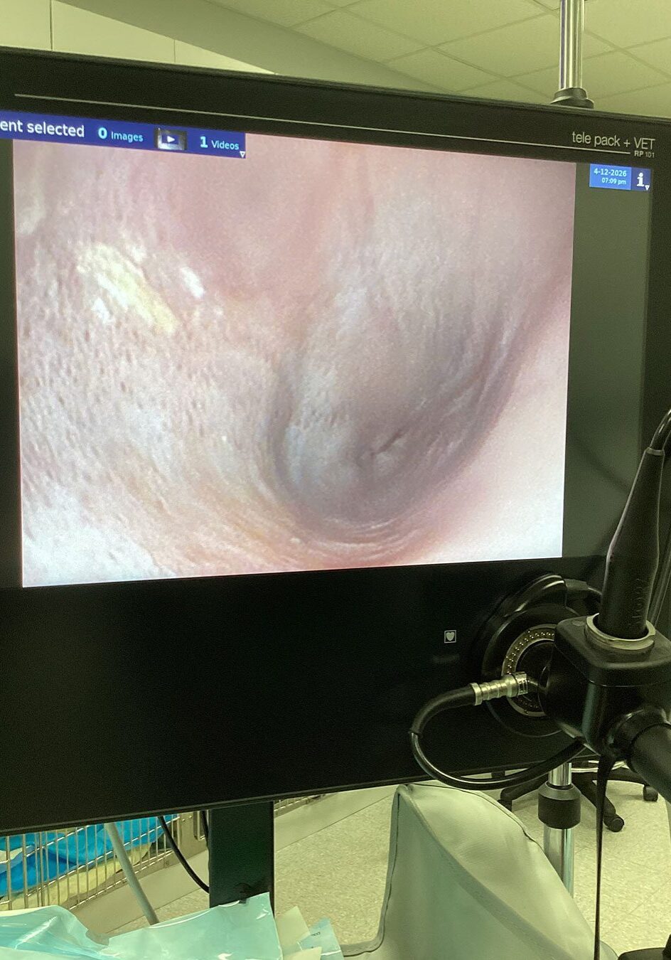 screen showing endoscopy procedure with endoscope tool set up